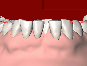 aligner setup