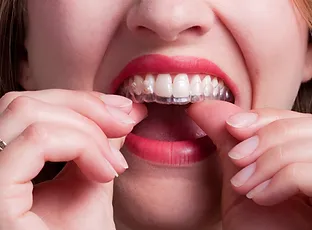 aligners