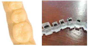 For Indirect Bonding (IDB)